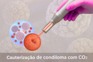Cauterização de Condilomas com CO2