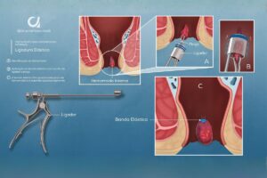 Ligadura Elástica para Hemorroidas: O Tratamento Ambulatorial de Primeira Escolha (Graus I a III)